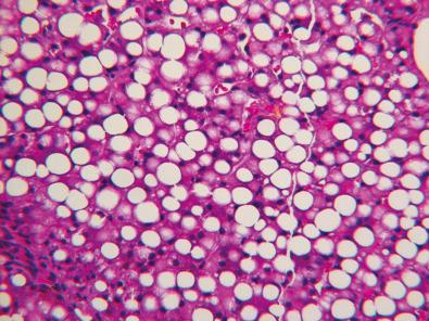 Figure 7.4, Macrovesicular steatosis in an infant with failure to thrive caused by malabsorption syndrome due to cystic fibrosis.