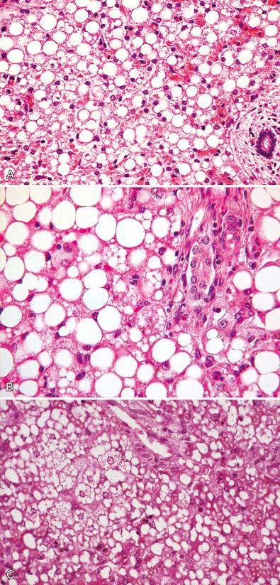 Figure 7.5, Fatty acid oxidation/transport defects. A, Mixed macrovesicular and microvesicular steatosis: acute metabolic crisis in medium-chain acyl-CoA dehydrogenase defect. B, Mixed macrovesicular and microvesicular steatosis: long-chain acyl-CoA dehydrogenase defect (autopsy). C, Mixed macrovesicular and microvesicular steatosis: lethal carnitine palmitoyltransferase 2 defect in infant.