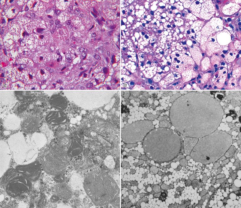 Figure 7.6, Mitochondriopathy. A, Nonuniform microvesicular steatosis and scattered granular red hepatocytes (oncocytes) in mDNA depletion due to MPV17 defect. B, Nonuniform microvesicular steatosis without granular red hepatocytes (oncocytes) in mDNA depletion due to MPV17 defect. C, Mitochondria in mDNA depletion are pleomorphic with variable abnormal density of matrix. MPV17 defect (electron microscopy). D, Massively enlarged mitochondria due to increased matrix with displacement of cristae to periphery in MPV17 defect (electron microscopy).