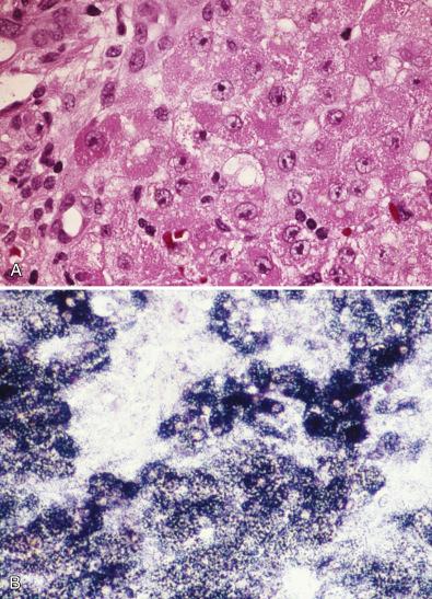 Figure 7.7, Alpers disease with valproate-associated liver failure. A, Triad of features includes mild fatty change, scattered granular red hepatocytes, and focal chronic inflammation. B, Tetrazolium reductase reaction product indicative of mitochondrial numbers is abnormally heavy in frozen section of liver (succinate dehydrogenase histochemistry).
