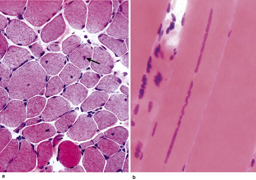 Fig. 4.20, (a) Internal nuclei (arrow) within fibres of varying size from a case of Duchenne muscular dystrophy (H&E). Fibre diameter range 15–60 μm. (b) A chain of internal nuclei in a longitudinally sectioned fibre 48 μm in diameter (H&E).