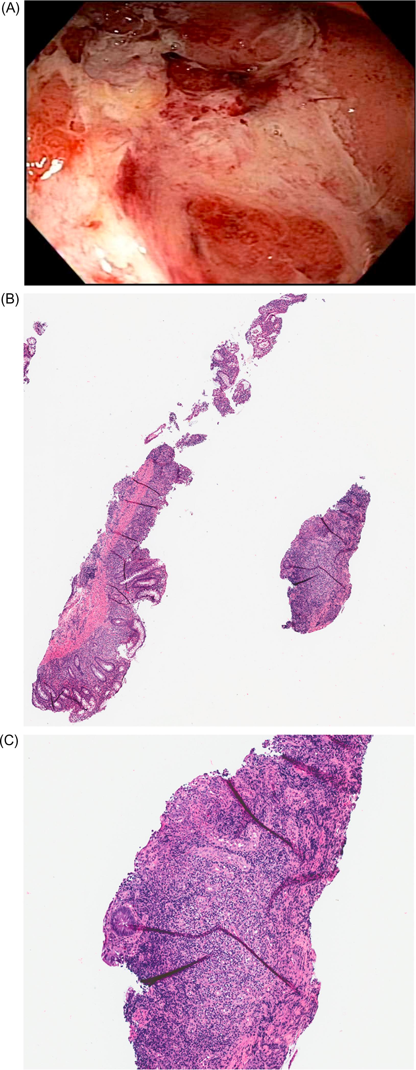 Figure 34.1, (A) UC can present with large deep ulcers. (B and C) Typical histology findings in UC include chronicity that is characterized by crypt distortion, basal lymphoplasmacytosis (B), and metaplasia and activity which is assessed by the neutrophil-associated epithelium injury from cryptitis, crypt abscess, and erosion to ulceration (C). UC , Ulcerative colitis.