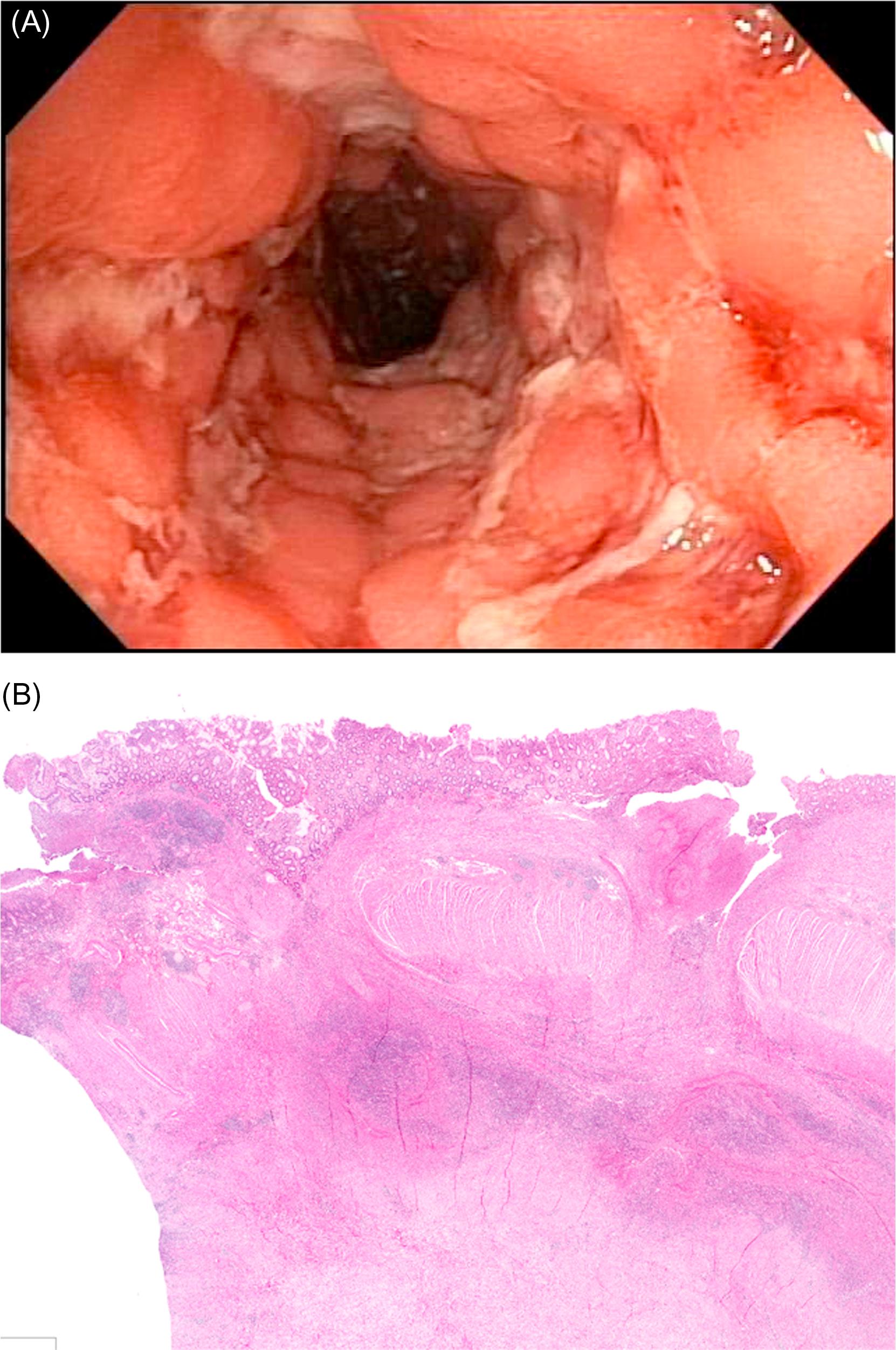 Figure 34.2, (A) CD presents with longitudinal ulcers and cobblestoning lesions.(B) Typical histologic findings are best demonstrated in resected segment affected by CD. The histology includes chronic active enterocolitis, fissuring ulceration, mural fibrosis and abscess, and serosal fibrous adhesions. CD , Crohn’s disease.