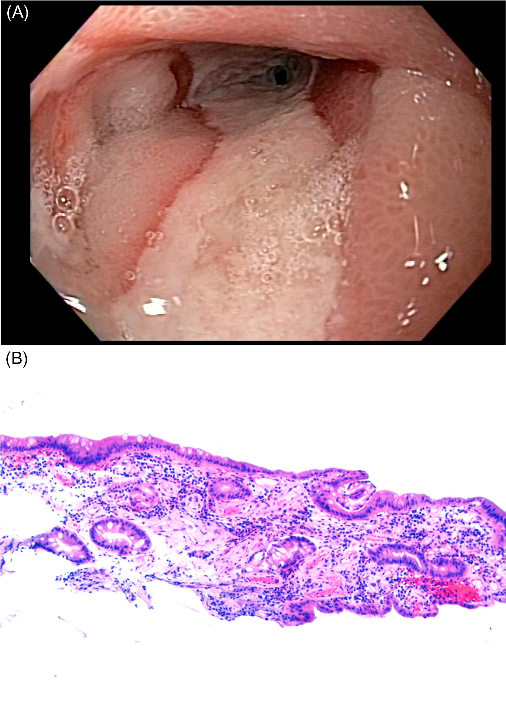 Figure 34.3, (A) CD presents with longitudinal ulcers and stenosis of small bowel lumen. (B) Biopsy from the stenotic mucosa shows mucosal fibrosis and dilated vessels. CD , Crohn’s disease.