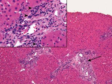 FIGURE 84-4, Moderate to severe ischemic/preservation injury.