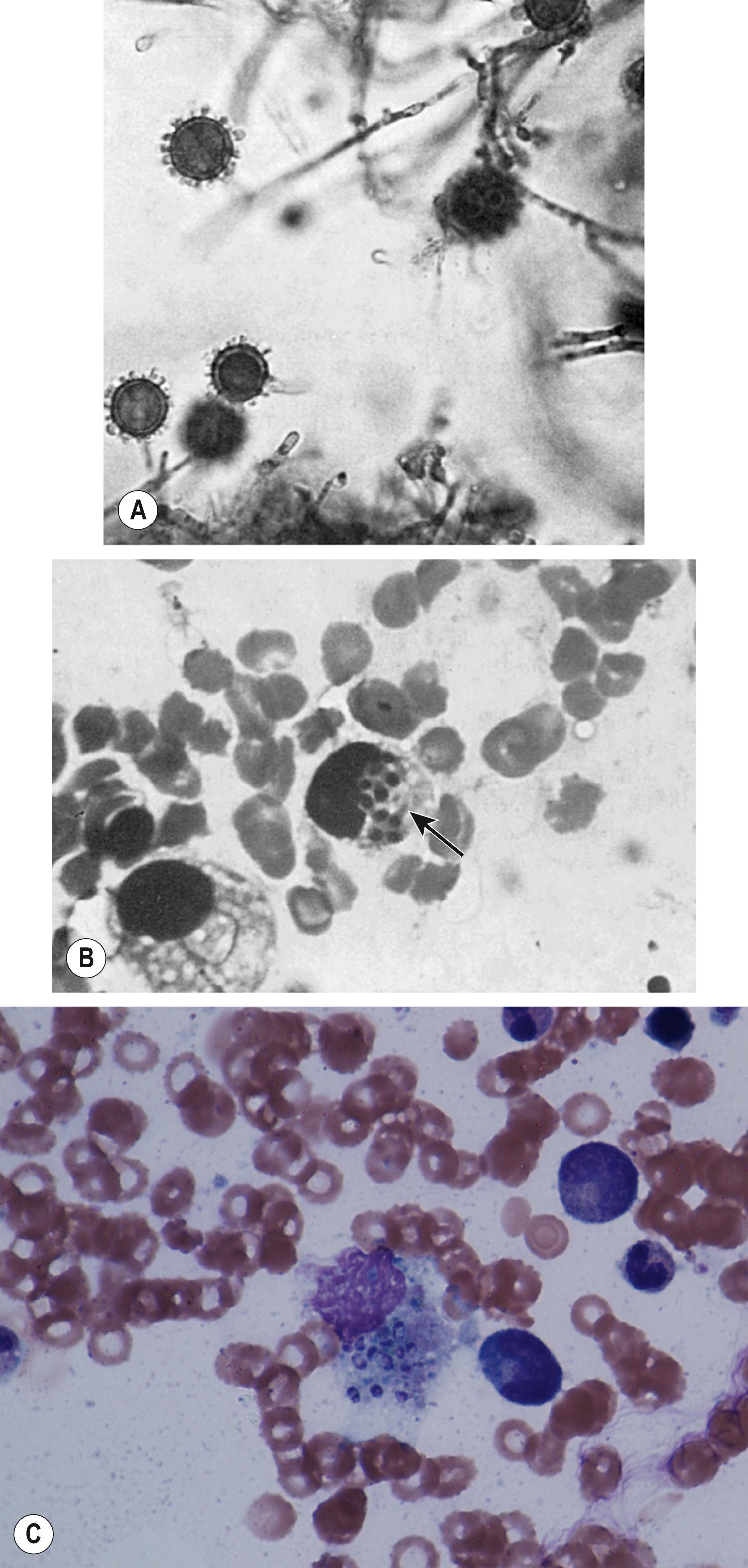 Figure 250.1, (A) Characteristic appearance of the tuberculate macroconidia of the mold form of Histoplasma capsulatum. Lactophenol cotton blue stain, ×400. (B) Yeast-like forms of H. capsulatum in tissue. Yeast-like forms typically are found phagocytosed by histiocytes (arrow) and are 2–3 μm in diameter. Giemsa stain, ×400. (C) Bone marrow smear demonstrating yeast-like forms of H. capsulatum.