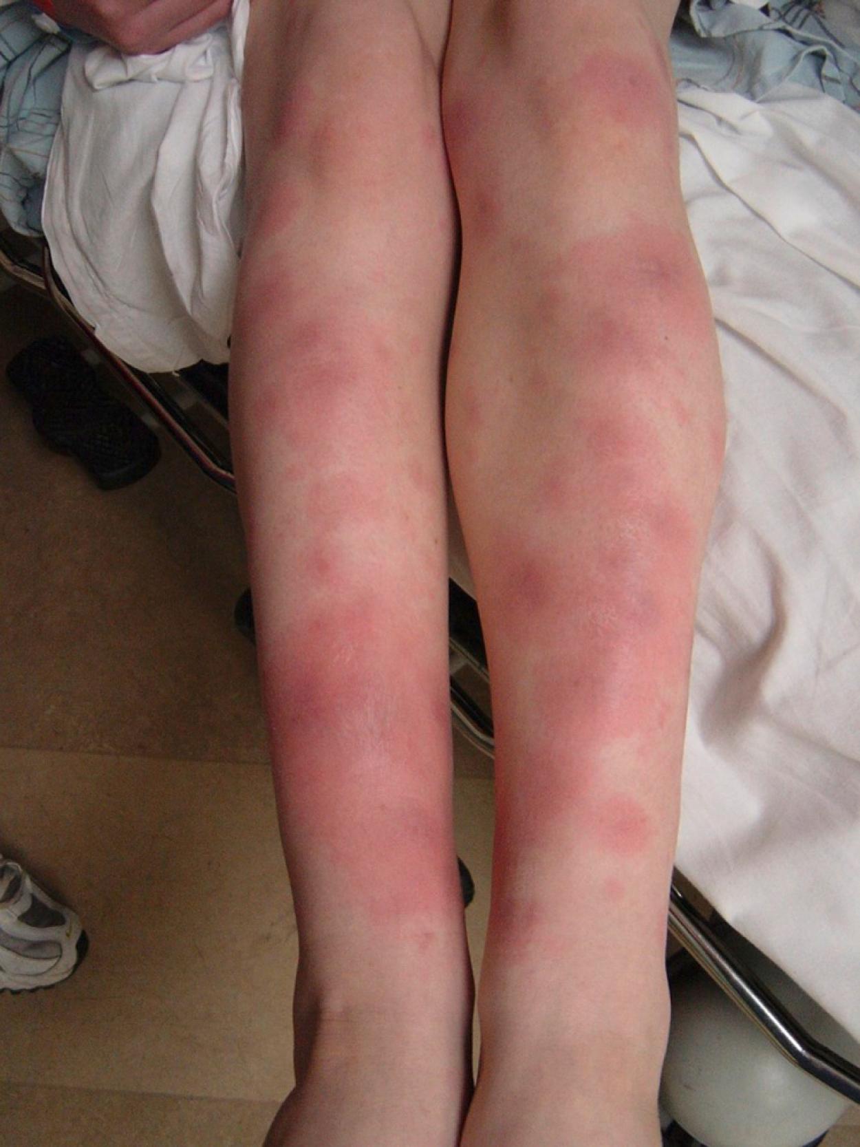 Figure 250.3, Erythema nodosum in an adolescent male with acute pulmonary histoplasmosis.