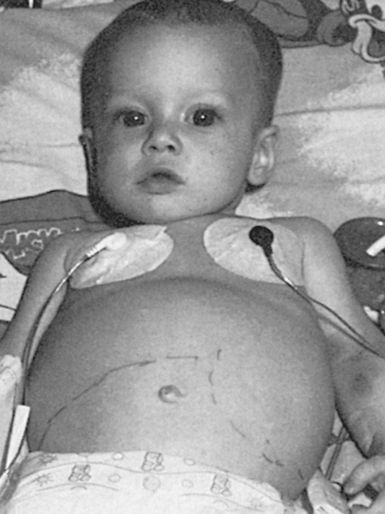 Figure 250.4, Six-month-old boy with disseminated histoplasmosis. He had a 1-month history of failing to thrive and a “swollen abdomen.” Note the characteristic appearance with massive hepatosplenomegaly and early signs of cachexia, yet the baby has a bright, responsive facial appearance.