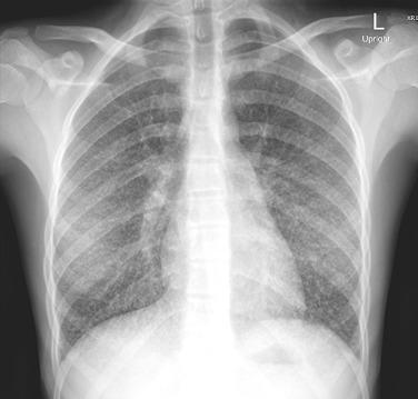 Fig. 28.1, Diffuse pneumonitis in an adolescent with disseminated histoplasmosis