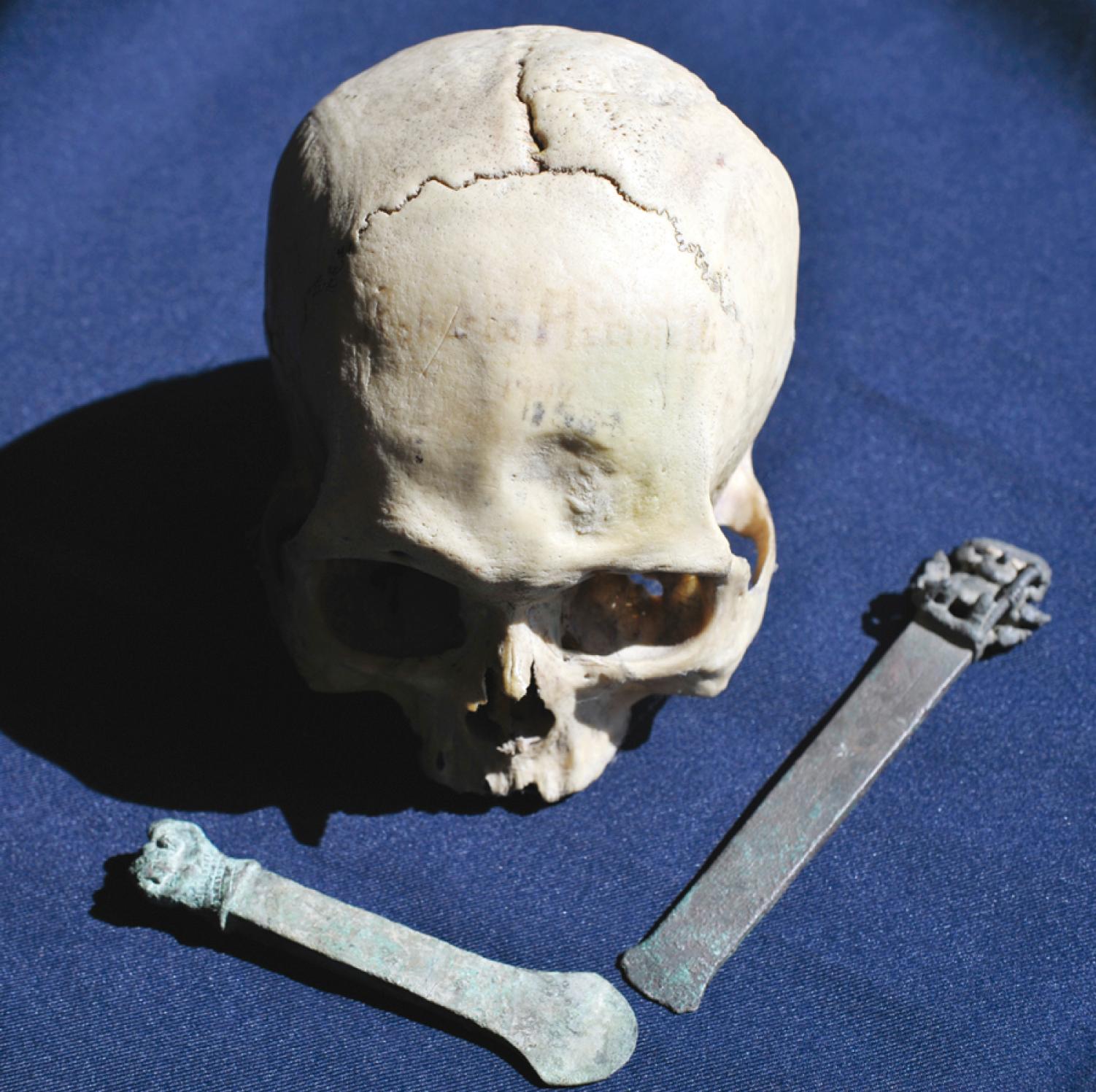 Figure 1.1, A skull from Peru with a left frontal trephination accomplished by the “scraping” technique.
