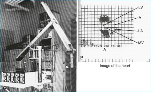 Figure 1-1, A, The mechanical arm used by Dekker and colleagues 1 for tracking the ultrasound transducer in space. Note the arrow depicting the actual ultrasound transducer. As might be imagined, this apparatus was not well received by sonographers because moving the transducer around was physically taxing, given the weight and awkwardness of the mechanical arm. B, Image of the heart. Note that the image shows only mild resemblance to the actual heart and heart chambers. A, aorta; LA, left atrium; LV, left ventricle; MV, mitral valve.