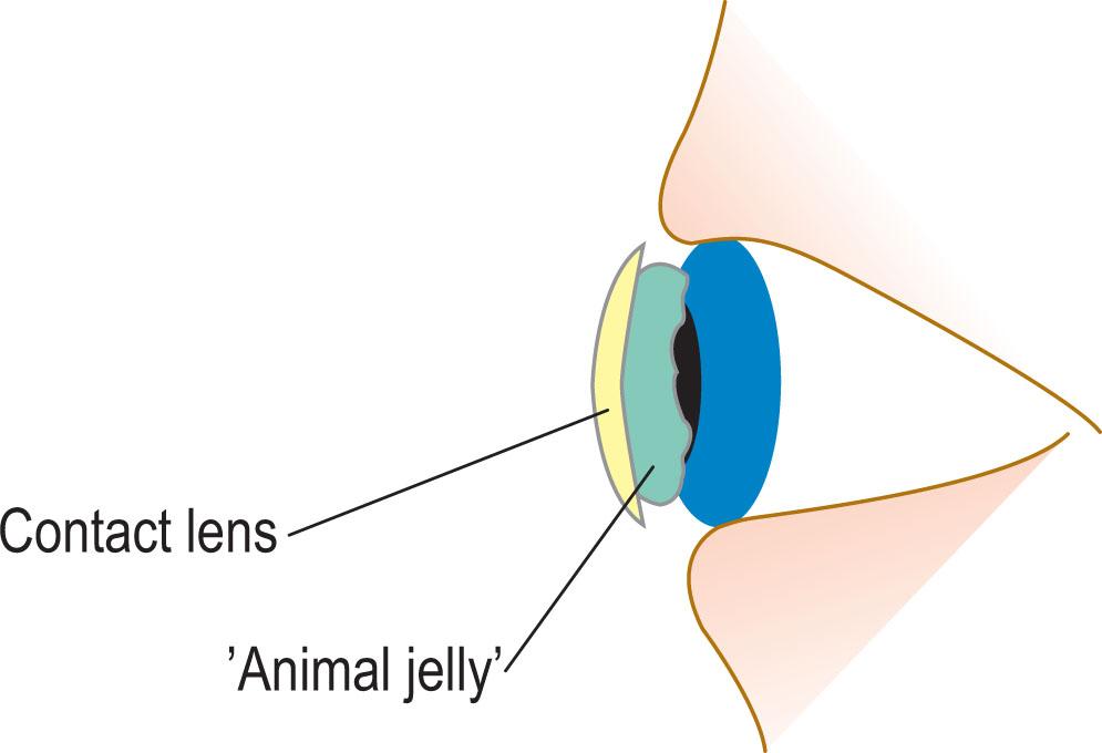 Fig. 1.5, ‘Animal jelly’ sandwiched between a ‘spherical capsule of glass’ (contact lens) and cornea, as proposed by Sir John Herschel.
