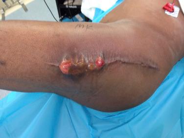 FIGURE 74.2, A patient presented with an infected joint after total joint arthroplasty. Signs included swelling, erythema, warmth and tenderness to palpation, a poorly healed wound, and a sinus tract with purulent drainage.