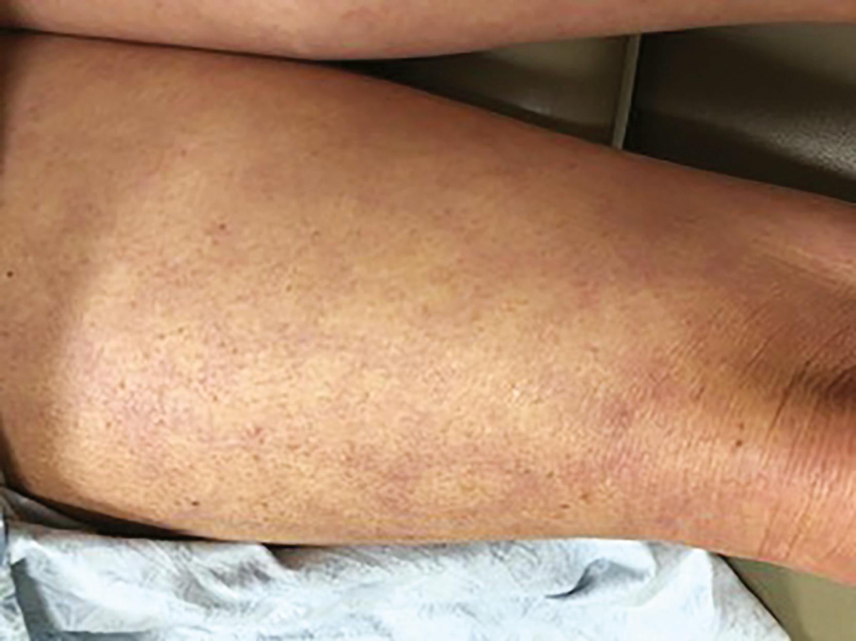 FIGURE 13.1, Appearance of livedo reticularis suggesting decreased skin perfusion.