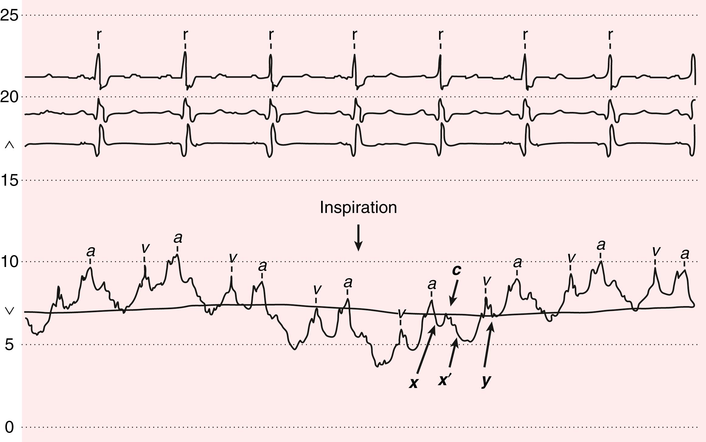 FIGURE 13.3, The normal jugular venous waveform recorded at cardiac catheterization. Note the inspiratory fall in pressure and the dominant x/x′ descent.