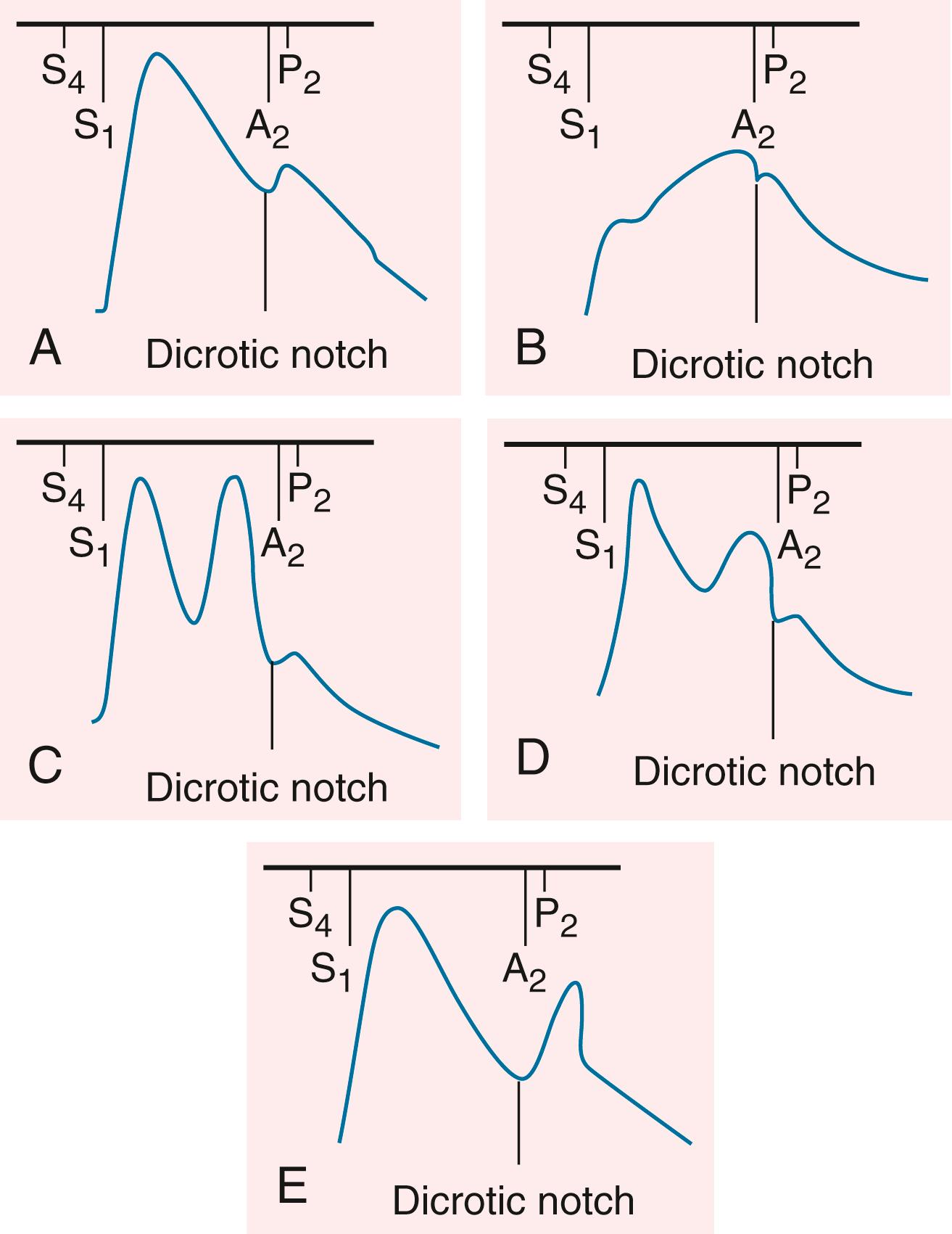 FIGURE 13.4, Carotid pulse waveforms and heart sounds. A, Normal. B, Aortic stenosis. Anacrotic pulse with slow upstroke and peak near S 2 . C, Severe aortic regurgitation (AR): bifid pulse with two systolic peaks. D, Hypertrophic obstructive cardiomyopathy (HCM): bifid pulse with two systolic peaks. The second peak (tidal or reflected wave) is of lower amplitude than the initial percussion wave. E, Bifid pulse with systolic and diastolic peaks as may occur with sepsis or intra-aortic balloon counterpulsation. A 2 , Aortic component of S 2 ; P 2 , pulmonic component of S 2 .
