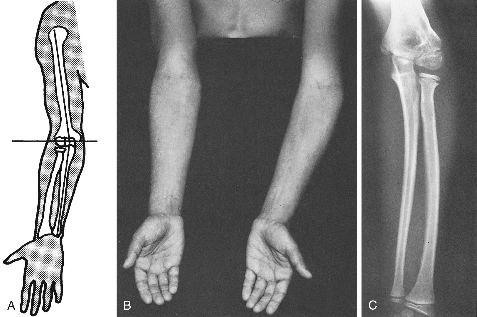 FIG 4.2, (A) The carrying angle is a clinical measurement of the angle formed by the forearm and the humerus with the elbow extended. (B,C) The normal 10- to 15-degree carrying angle can be altered by injury about the elbow, causing a varus carrying angle, or so-called gunstock deformity.