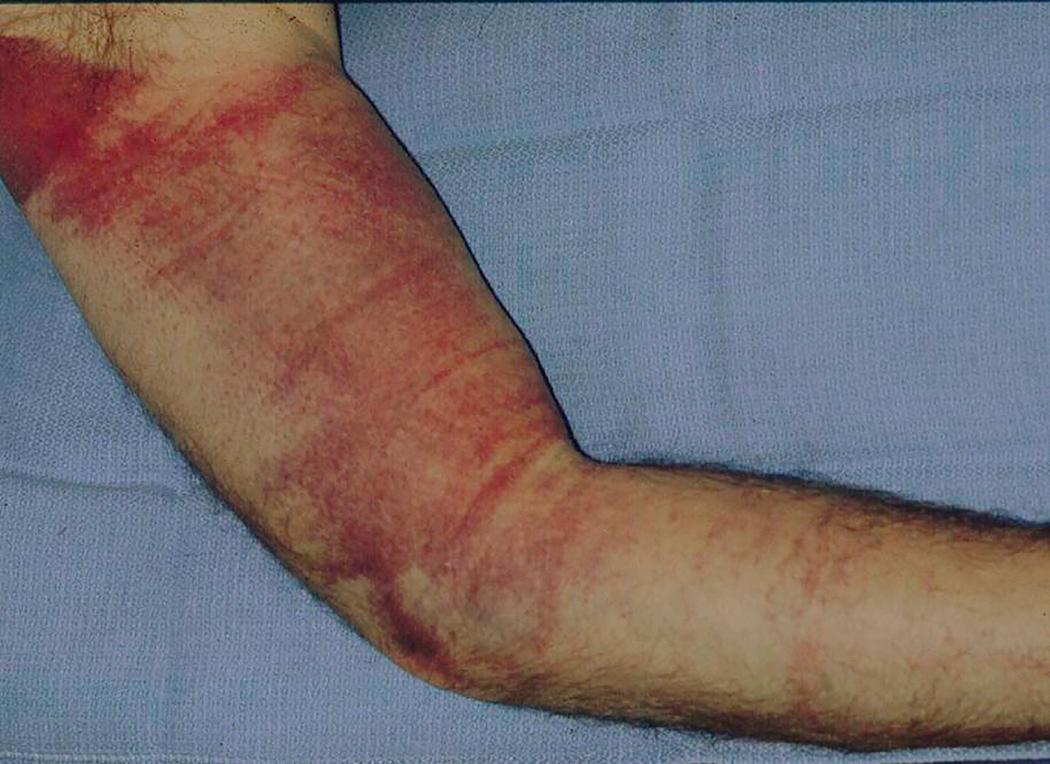 FIG 4.3, Significant arm and forearm bruising after left elbow distal biceps tendon rupture.