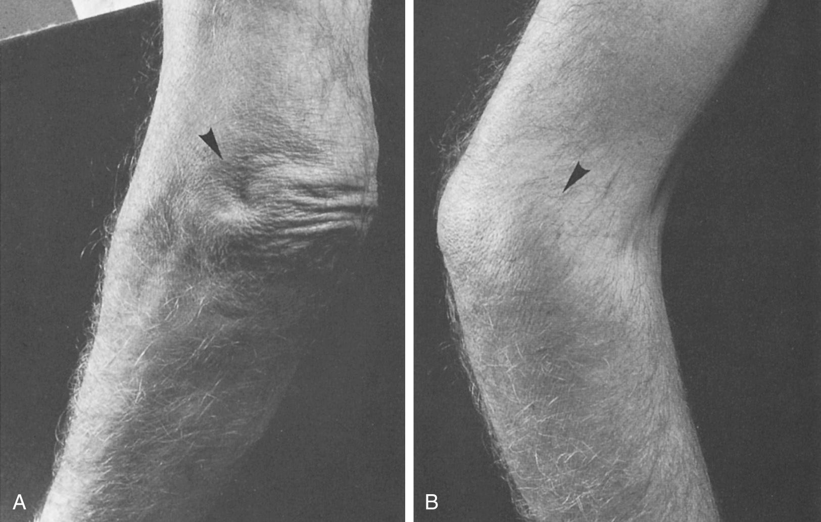 FIG 4.5, (A) A normal depression in the contour of the skin in the intracondylar recess (arrowhead) (B) becomes obliterated in the presence of synovitis or effusion.