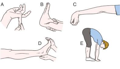 Fig. 28.3, Beighton assessment of hypermobility. (A) Hyperextension of the little finger beyond 90 degrees. (B) Passive apposition of the thumb to the flexor aspect of the forearm. (C) Hyperextension of the elbow beyond 10 degrees. (D) Hyperextension of the knee beyond 10 degrees. (E) Forward flexion of the trunk so that the palms of the hands rest easily on the floor.