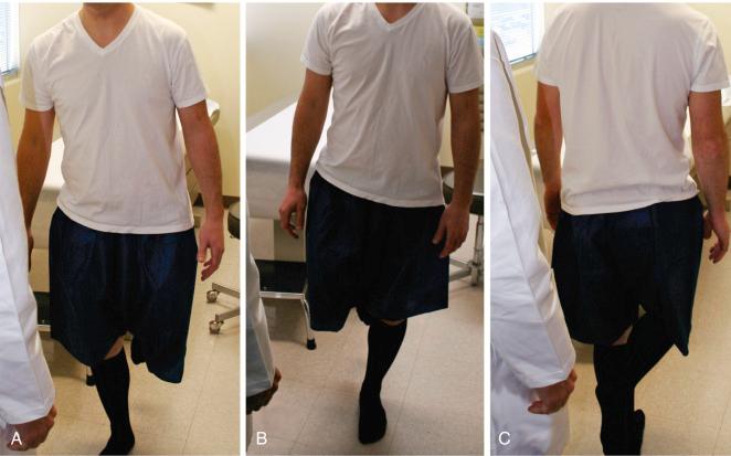 Fig. 28.4, The single-leg stance phase test. The single-leg stance phase test is performed bilaterally and is observed from behind and in front of the patient. The patient holds this position for 6 seconds. A pelvic shift of greater than 2 cm is a positive, indicating abductor weakness or proprioception disruption. (A) Right leg, front view. (B) Left leg, front view (note the positive pelvic shift). (C) Left leg, rear view.