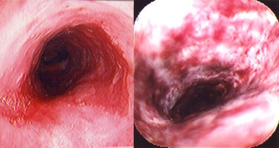 Figure 10.1, Barrett’s esophagus pretreatment (left). Three days posttreatment with PDT (right).