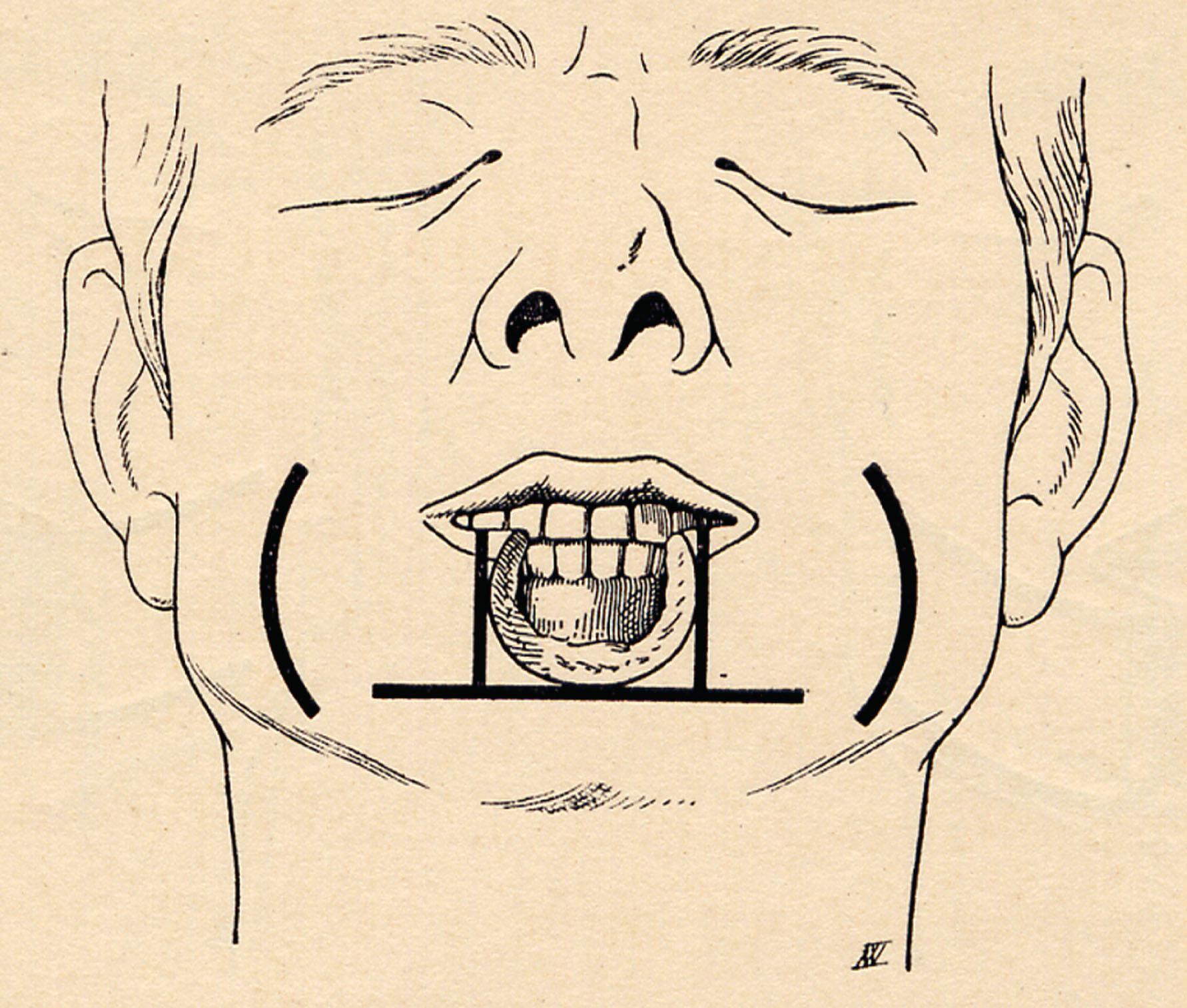 Figure 2.3, Lip repair according to Celsus.