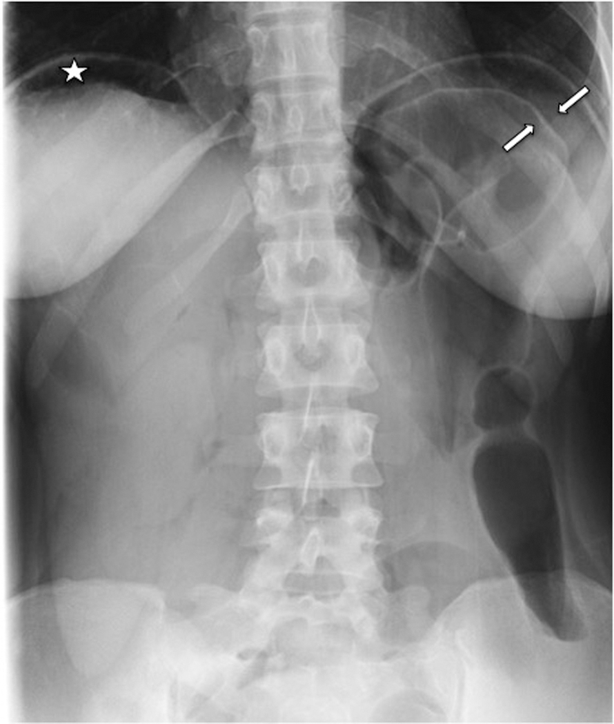 Fig. 4.1, Erect single view radiograph of the abdomen demonstrates free air under the diaphragm ( asterisk ). Air may also be seen on both sides of a loop of bowel in the left upper quadrant (Rigler’s sign) ( arrows ).