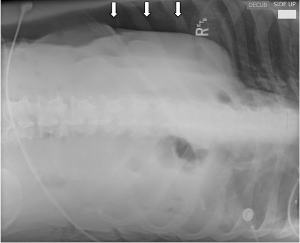 Fig. 4.2, Left lateral decubitus view of the upper abdomen demonstrates free air over the liver ( arrows ).