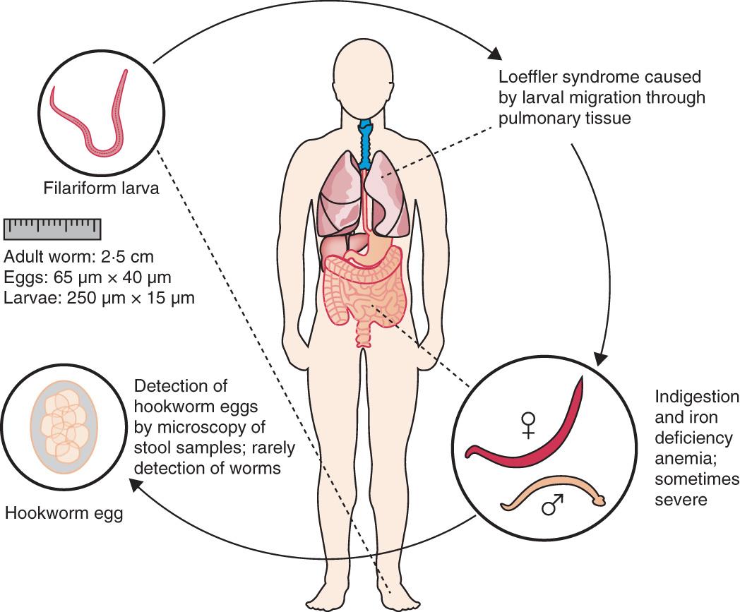 Fig. 318.1, Transmission of hookworm ( Ancylostoma duodenale and Necator americanus ): diagnosis and clinical features.