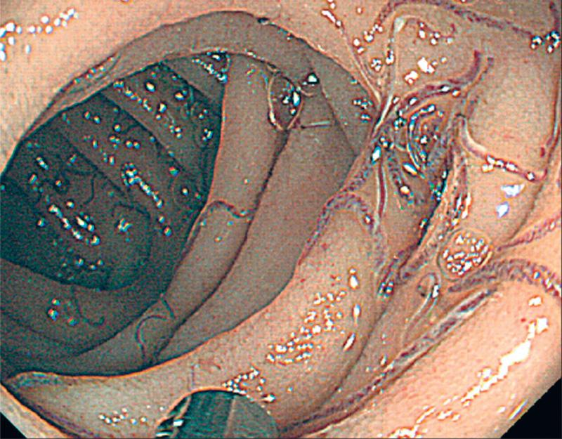 Fig. 318.2, Endoscopic images of intestinal hookworm infection.