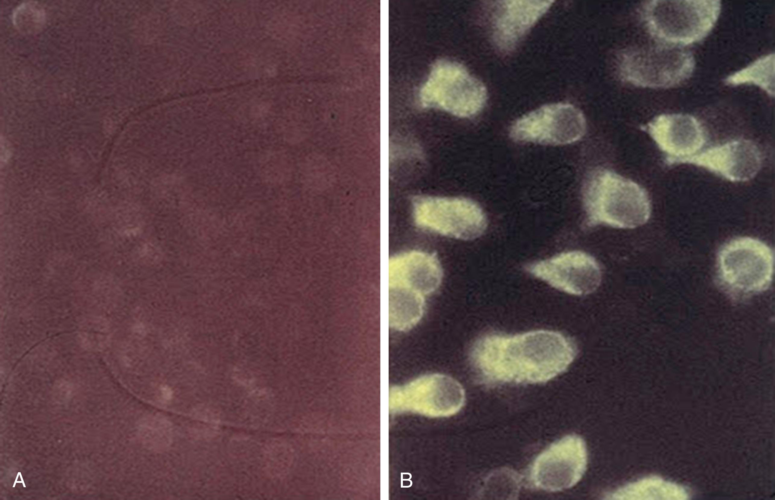 Fig. 114.2, Mannose receptor (MR) expression on blood monocytes (MO; A) and monocyte-derived macrophages (MDM; B). In an indirect immunofluorescence assay MDMs, in contrast with MOs, were shown to express clearly detectable MR expression after treatment with rabbit anti-human MR.