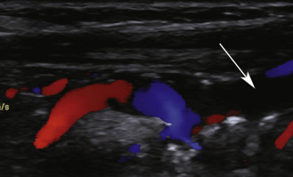 FIG. 8.1, Common carotid artery occlusion. A color Doppler image shows absence of blood flow in the common carotid artery ( arrow ). Forward blood flow is identified in the internal carotid artery ( red ) and is supplied from the external carotid artery ( blue ).