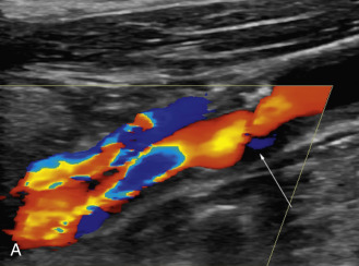 FIG. 8.11, Case 1. (A) Right internal carotid artery ( ICA ) color flow image demonstrates plaque and narrowing ( arrow ). (B) Right distal common carotid artery ( CCA ) color flow image and Doppler spectral analysis with peak systolic velocity of 100.3 cm/s. (C) Right ICA color flow image with Doppler sample in the stenosis with peak systolic velocity of 282.9 cm/s. (D) Left distal CCA with peak systolic velocity of 80.6 cm/s. (E) Left ICA color flow image showing a tight stenosis with peak systolic velocity of 821 cm/s. (F) Curved planar reformatted computed tomographic angiogram revealing a 65% stenosis of the right ICA and severe stenosis of the left ICA.