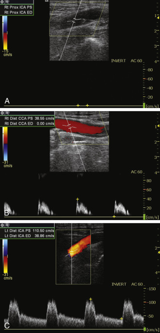 FIG. 8.2, Internal carotid artery ( ICA ) occlusion. (A) No flow signals are present in the ICA, and the vessel is filled with minimally echogenic material. (B) High-resistance, low-velocity flow is noted in the common carotid artery ( CCA ), consistent with outflow obstruction. (C) Slightly elevated velocities are seen in the contralateral ICA (110.5 cm/s), consistent with compensatory flow.