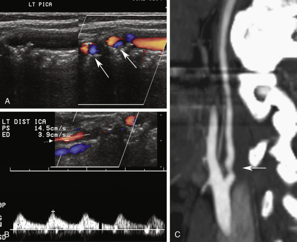 FIG. 8.3, Near occlusion of the internal carotid artery ( ICA ). (A) Irregular plaque and discontinuous color flow is noted on the gray-scale and color Doppler images of the proximal left ICA consistent with severe narrowing of the vessel ( arrows ). At first glance, it appears that the ICA is occluded, but with diligent scanning, flow is identified by focal areas of color. (B) There is extension of plaque into the distal ICA on the color Doppler display, indicating diffuse disease. Pulsed Doppler of the ICA shows extremely low flow velocity (14.5 cm/s) and tardus-parvus waveforms consistent with severe inflow abnormality. (C) Computed tomographic angiography demonstrates a tight narrowing in the proximal ICA ( arrow ) consistent with a high-grade stenosis. PICA , Proximal internal carotid artery.