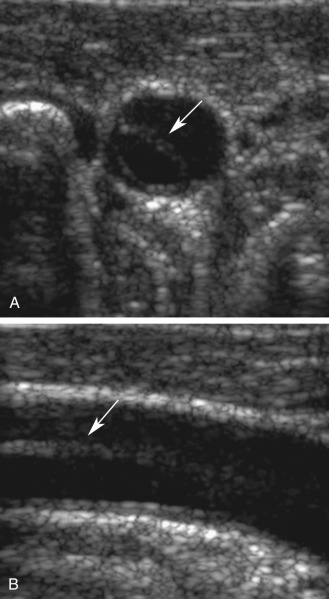 FIG. 8.4, Common carotid artery (CCA) dissection extending from the aorta. (A) This transverse gray-scale image shows an intimal flap ( arrow ) in the lumen of the CCA. (B) Longitudinal gray-scale image of the CCA also shows the intimal flap ( arrow ).