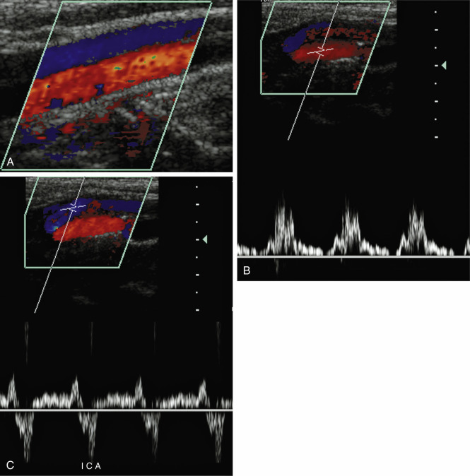 FIG. 8.5, Common carotid artery dissection. (A) This longitudinal color flow image shows division of the common carotid artery into two lumens. In this case, the dissection membrane was thick and moved very little with each arterial pulse. (B) Doppler waveforms in the bottom lumen have continuous forward flow throughout the cardiac cycle, suggesting that this is the true lumen. (C) To-and-fro flow is present in the top lumen, suggesting it is the false lumen. ICA , Internal carotid artery.