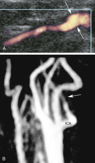 FIG. 8.6, Spontaneous internal carotid artery ( ICA ) dissection. (A) Power Doppler image shows the ICA abruptly tapers from its normal size ( arrows ) at its origin. It is smoothly narrowed throughout its length. (B) Magnetic resonance angiography in the same patient shows diffuse narrowing of the ICA ( arrow ) beyond its origin, consistent with dissection.