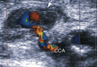 FIG. 8.7, Carotid pseudoaneurysm. Color flow examination shows a pseudoaneurysm ( arrowhead ) connected with the common carotid artery ( CCA ) by a thin neck.