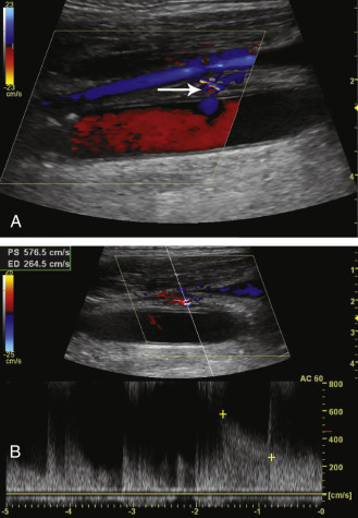 FIG. 8.8, Carotid arteriovenous fistula. (A) This longitudinal color flow image shows a short tract ( arrow ) connecting the common carotid artery (CCA) with the internal jugular vein. (B) Doppler interrogation of the fistula shows arterialized high-velocity waveforms (>576 cm/s) with spectral broadening.