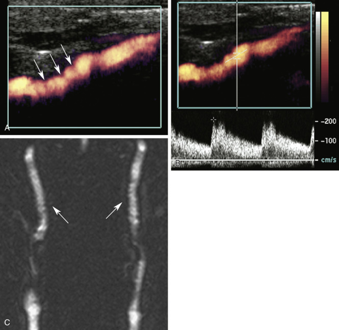 FIG. 8.9, Carotid fibromuscular dysplasia. (A) This power Doppler image shows a series of ridges ( arrows ) along the lumen of the internal carotid artery (ICA) characteristic of fibromuscular dysplasia (FMD). This is called the “string-of-pearls” sign. (B) Spectral Doppler shows moderate flow disturbance and elevation of flow velocity (about 200 cm/s). (C) Magnetic resonance angiography shows the classic ridged appearance in both ICAs ( arrows ).