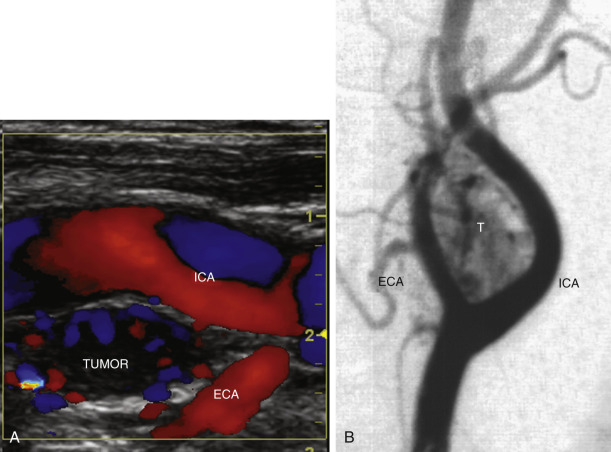 FIG. 8.10, Carotid body tumor. (A) This longitudinal color flow image shows a homogeneous, hypoechoic tumor ( TUMOR ), which splays the internal carotid artery ( ICA ) and external carotid artery ( ECA ) branches. Blood flow ( color areas ) was easily detected in the tumor. (B) Carotid arteriography in the lateral projection shows the highly vascular nature of the mass ( T ).