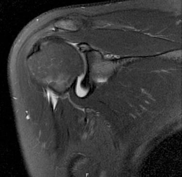 FIG. 45.1, Coronal T2-weighted MRI arthrogram demonstrating a SLAP (superior labrum anterior and posterior) lesion.