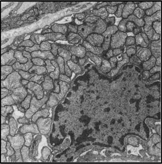 Fig. 25.1, Electron Microscopy Showing Abundance of Mitochondria in Hürthle Cell Cancer.