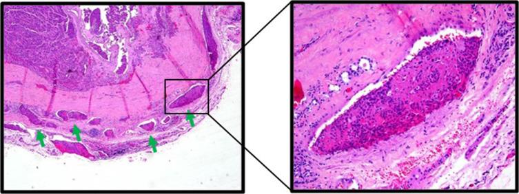 Fig. 25.2, Hürthle Cell Carcinoma (Widely Invasive) Showing Vascular Invasion.