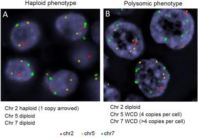 Fig. 25.3, Fluorescence In Situ Hybridization (FISH) Showing Chromosomal Alterations in Hürthle Cell Carcinoma.