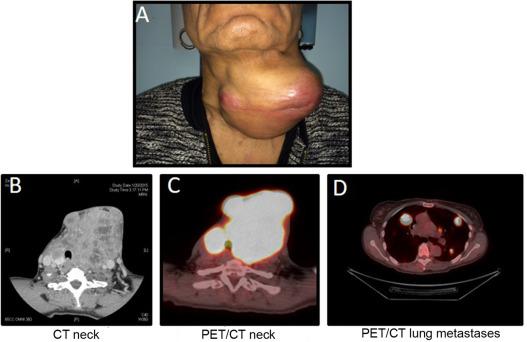 Fig. 25.5, Clinical presentation of patient with widely invasive Hürthle cell carcinoma (HCC) (A) . Gross extrathyroid extension is shown on computed tomography (CT) image (B) with corresponding positron emission tomography (PET) image (C) . Presence of PET avid lung metastases is shown in (D) .