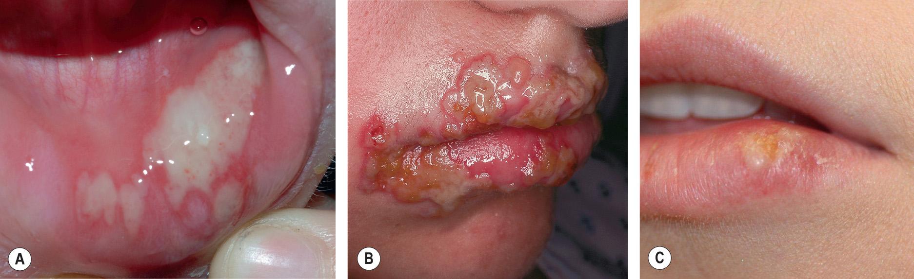 Fig. 80.1, Orolabial herpes simplex virus (HSV) infections.