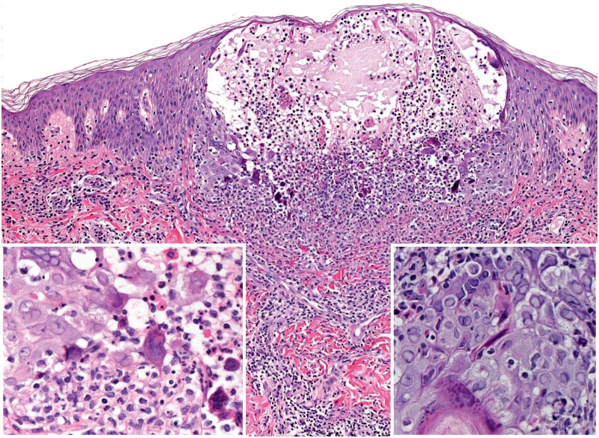 Fig. 80.12, Histology of herpes simplex viral infection.